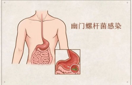 辟谣 | 吃大蒜能杀幽门螺杆菌？真的假的？