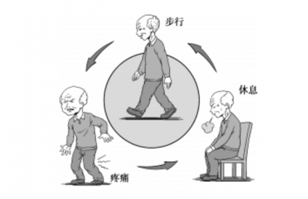 健康问答|什么是间歇性跛行？