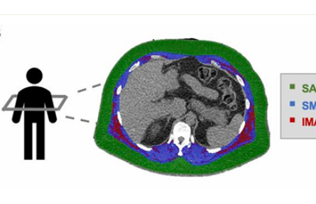 骨骼肌肌间脂肪多，心血管病风险高