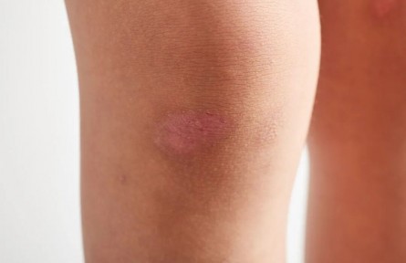 辟谣|疤痕膏可以完全祛除疤痕？